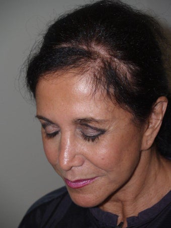 Hair Transplant into Scar before 336980