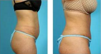 Tummy Tuck (Abdominoplasty) 324843