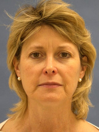 Facelift, Endoscopic Browlift, Upper and Lower Blepharoplasty, Lip Augmentation with Alloderm Grafts before 248832