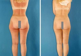 Liposuction before 636213