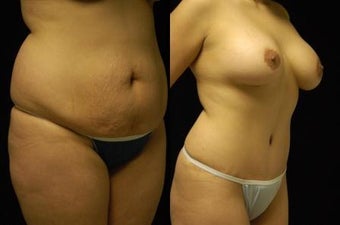 Tummy Tuck and Breast Augmentation- gel implants after 392664