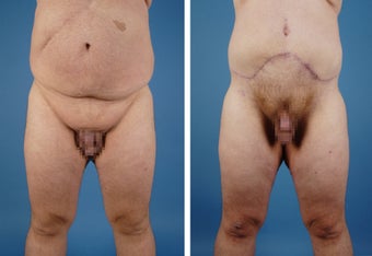 Upper & Lower Body Lift before 335976