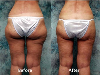 Inner and outer thigh liposuction before 124250