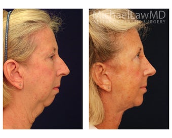 Facial Rejuvenation 395135