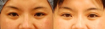 Asian Eyelid Surgery before 489331