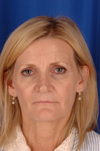 Endoscopic brow lift, open neck lift, facelift, lower blepharoplasty and fat transfer to lips before 385614