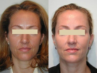 Radiesse for Nasolabial Folds before 137719