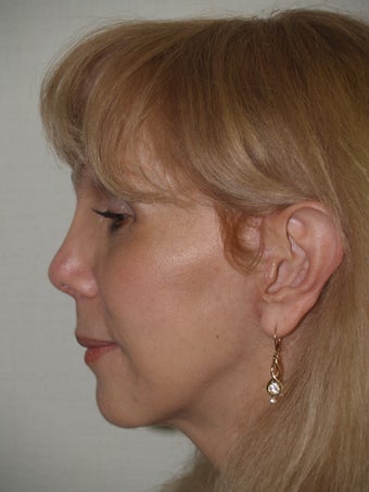 Revision rhinoplasty after 172859