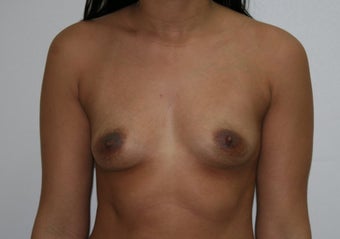 Breast augmentation before 88869