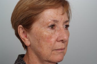 Fractionated CO2 laser resurfacing before 253092