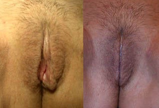 Before & After Labiaplasty Surgery (labia minora reduction) before 159555