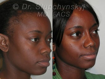 African American Rhinoplasty after 565837