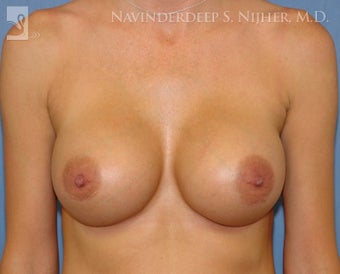 Breast Augmentation after 500539