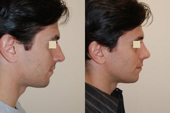 Rhinoplasty, 6 weeks post op. before 150798