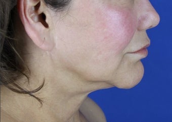 Facelift, Neck Lift, Lipocontouring of Neck before 414152