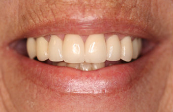 Full Porcelain Crowns after 145686