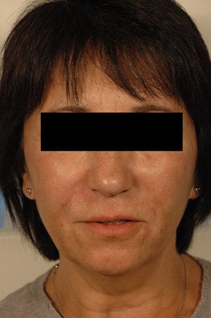 Juvederm for laugh lines after 199421