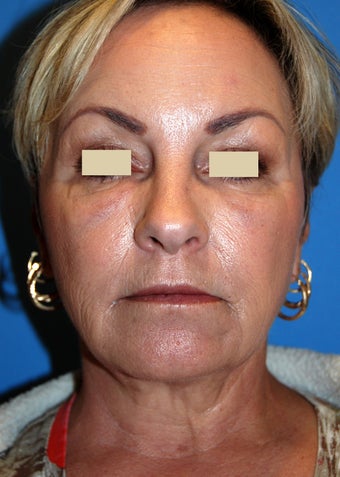YoungLift ~ Fat Transfer (Full Face) after 139186
