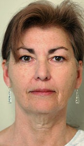 Before and After Neck Lift (Front View) before 65350