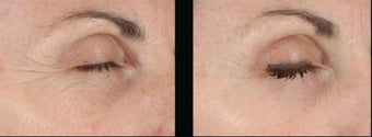 Ultherapy before 460620