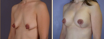 Breast Implants before 270007