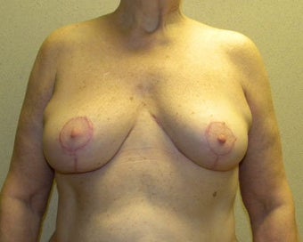 Breast Lift after 411125