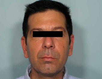 The Liquid Facelift for a Man after 349802