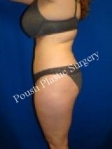 Liposuction 632171