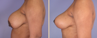 Breast Implant Removal before 270065