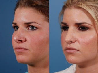 Revision rhinoplasty 395562