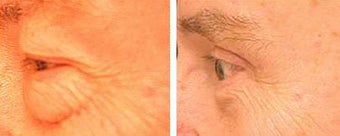 Blepharoplasty before 69349