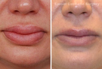 Lip Reduction and Repair before 485284