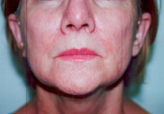 SmartXide CO2 Laser Resurfacing (DOT Therapy) 587714