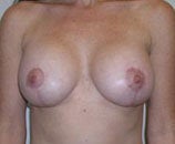 Breast Lift with Implants (Augmentation Mastopexy) after 142510