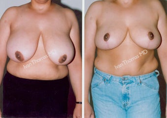 Breast Reduction before 243739