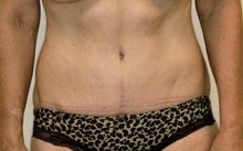 Tummy Tuck (Lipo Abdominoplasty) after 244000