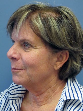 Neck Lift, Platysmaplasty 634723