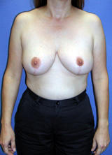 Breast Lift (mastopexy) Surgery after 122672