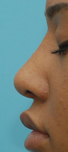 Rhinoplasty after 271667