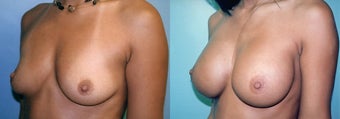 Large Breast Implants (450cc), Post-Pregnancy before 352757