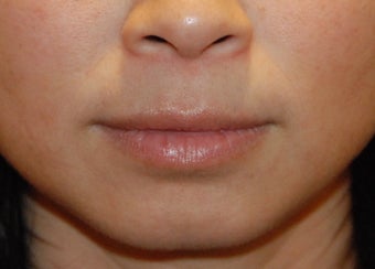 Lip Augmentation before 199331