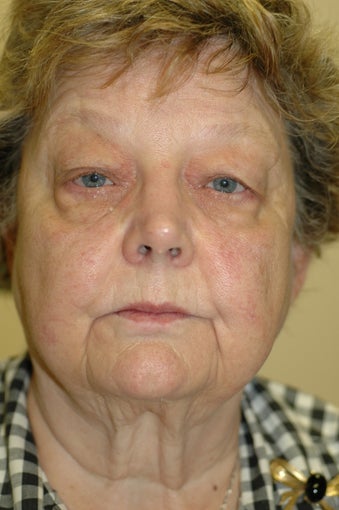 Bilateral upper and lower eyelid surgery before 341554