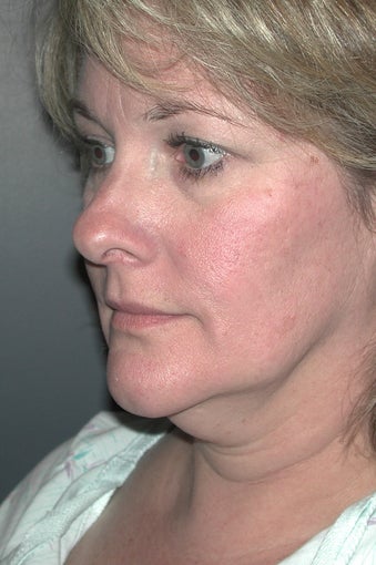 Facelift before 137854