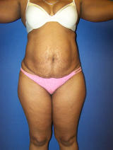 Tummy Tuck Surgery (abdominoplasty) before 129750