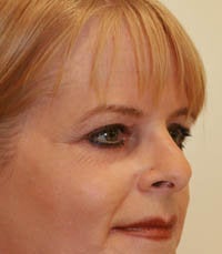 blepharoplasty (eyelids) after 219348