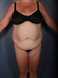 Tummy Tuck, Liposuction before 374144