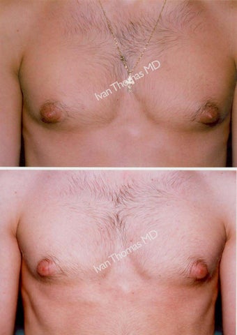 Male Breast reduction-Gynecomastia before 243678