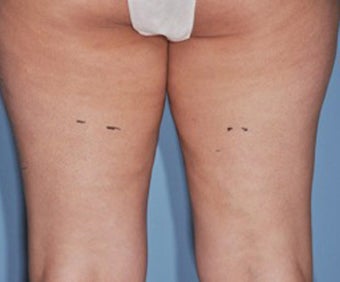 VASER Shape to Legs after 433059