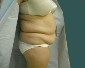 Extended abdominoplasty 561153