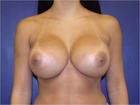 Breast augmentation after 592886